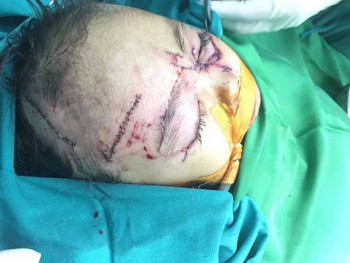 Nghệ An:  Bị chó nhà tấn công, 2 trẻ nhỏ phải nhập viện