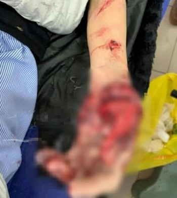 Thiếu niên bị dập nát bàn tay khi dùng điện thoại khi đang sạc pin