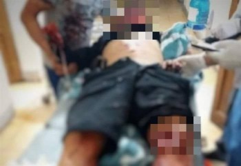 Nam thanh niên ở Hà Tĩnh bị dập nát bàn tay sau tiếng nổ lớn