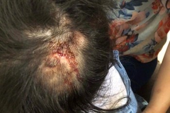 Thông tin mới vụ dì ruột đánh cháu 4 tuổi bầm tím khắp người ở Hà Tĩnh