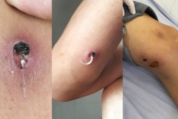 Cảnh báo căn bệnh hiếm gặp xuất hiện ở Việt Nam