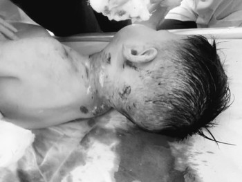 Bé 3 tuổi bị chó nhà hàng xóm cắn đến mức lộ xương sọ, đứt tĩnh mạch