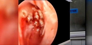 Dòi đóng ổ trong hốc mũi người phụ nữ