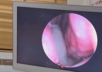 Người đàn ông 60 tuổi liên tục chảy máu mũi, bác sĩ gắp ra thứ "đáng sợ" bên trong