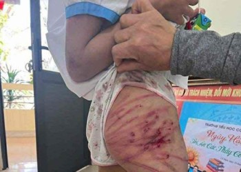 Làm rõ vụ bé gái ở Hà Tĩnh nghi bị cha dượng bạo hành