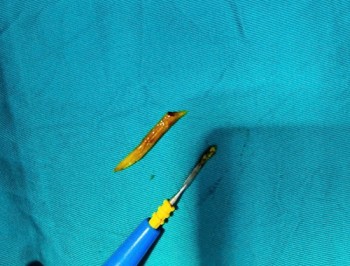 Nam bệnh nhân nhập viện cấp cứu vì xương cá kích thước lớn 'đi lạc' xuống... ruột non