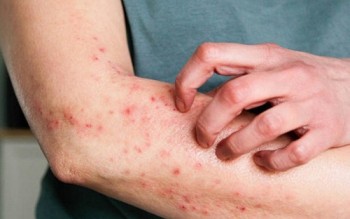 Bộ Y tế yêu cầu không để dịch bệnh viêm màng não mô cầu lan rộng tại cộng đồng