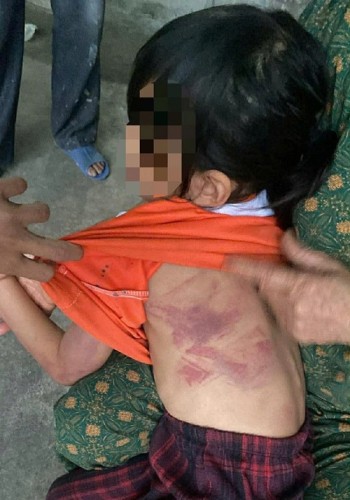 Bé gái lớp 2 bị bạn cùng lớp dùng thước đánh thâm tím người vì không cho kẹo