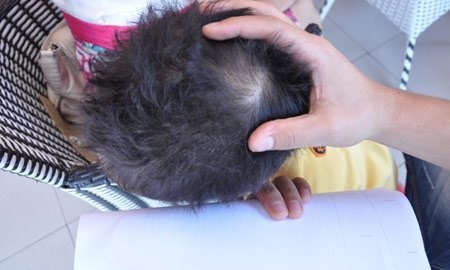 Giáo viên bị tố đánh “chấn động não” bé 3 tuổi